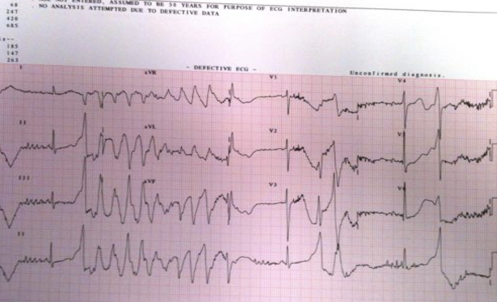 Is this Polymorphic VT?